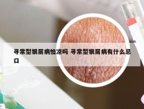 寻常型银屑病怕凉吗 寻常型银屑病有什么忌口