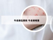 牛皮癣在那挑 牛皮癣哪里