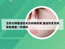 怎样分辨脂溢性皮炎和银屑病 脂溢性皮炎和银屑病是一种病吗
