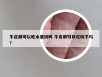 牛皮癣可以吃水蜜桃吗 牛皮癣可以吃桃子吗?