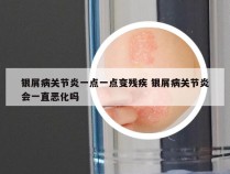 银屑病关节炎一点一点变残疾 银屑病关节炎会一直恶化吗