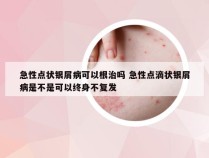 急性点状银屑病可以根治吗 急性点滴状银屑病是不是可以终身不复发