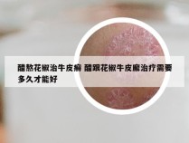 醋熬花椒治牛皮癣 醋跟花椒牛皮廨治疗需要多久才能好