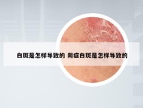 白斑是怎样导致的 阴症白斑是怎样导致的