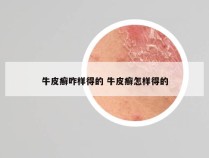 牛皮癣咋样得的 牛皮癣怎样得的