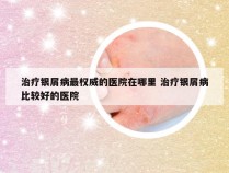 治疗银屑病最权威的医院在哪里 治疗银屑病比较好的医院