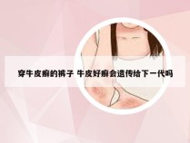 穿牛皮癣的裤子 牛皮好癣会遗传给下一代吗