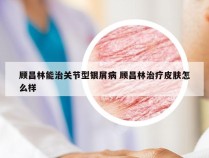 顾昌林能治关节型银屑病 顾昌林治疗皮肤怎么样