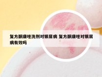 复方酮康唑洗剂对银屑病 复方酮康唑对银屑病有效吗