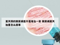 夏天得的银屑病是不是难治一些 银屑病夏天加重怎么回事