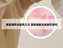 银屑病照光能照几次 银屑病照光有副作用吗