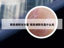 银屑病照光计量 银屑病照光是什么光