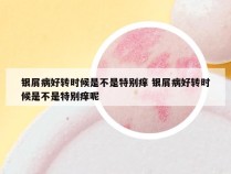 银屑病好转时候是不是特别痒 银屑病好转时候是不是特别痒呢
