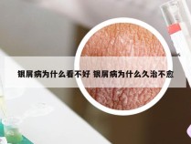 银屑病为什么看不好 银屑病为什么久治不愈