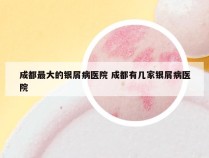 成都最大的银屑病医院 成都有几家银屑病医院