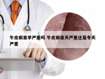 牛皮癣夏季严重吗 牛皮癣夏天严重还是冬天严重