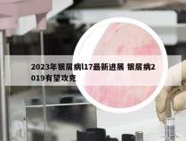 2023年银屑病l17最新进展 银屑病2019有望攻克
