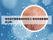 郑州治疗银屑病来W刘长江 郑州市银屑病研究口碑