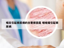 喉炎引起银屑病的主要原因是 喉咙痛引起银屑病