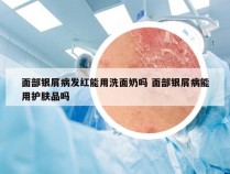 面部银屑病发红能用洗面奶吗 面部银屑病能用护肤品吗