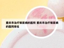 重庆市治疗银屑病的医院 重庆市治疗银屑病的医院排名