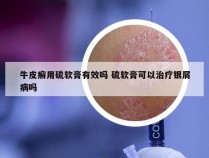 牛皮癣用硫软膏有效吗 硫软膏可以治疗银屑病吗