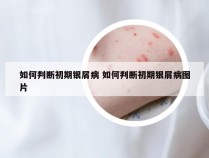 如何判断初期银屑病 如何判断初期银屑病图片