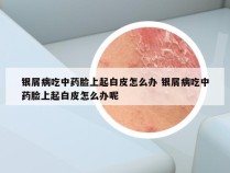 银屑病吃中药脸上起白皮怎么办 银屑病吃中药脸上起白皮怎么办呢