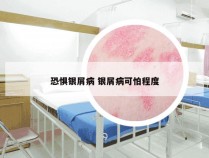 恐惧银屑病 银屑病可怕程度