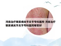 河南治疗银屑病关节炎节专科医院 河南治疗银屑病关节炎节专科医院哪家好