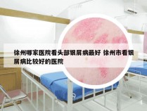徐州哪家医院看头部银屑病最好 徐州市看银屑病比较好的医院