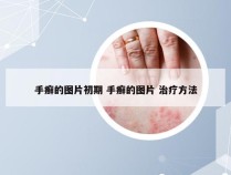 手癣的图片初期 手癣的图片 治疗方法