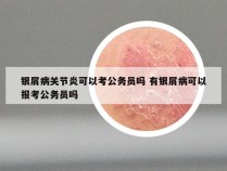 银屑病关节炎可以考公务员吗 有银屑病可以报考公务员吗