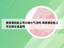 银屑病在脸上可以做小气泡吗 银屑病在脸上可以抹化妆品吗