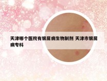 天津哪个医院有银屑病生物制剂 天津市银屑病专科