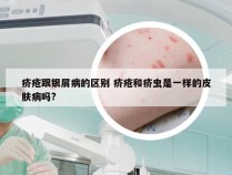 疥疮跟银屑病的区别 疥疮和疥虫是一样的皮肤病吗?