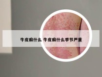 牛皮癣什么 牛皮癣什么季节严重