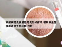银屑病是先脱屑还是先出红疹子 银屑病是先脱屑还是先出红疹子呢