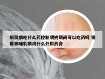 银屑病吃什么药控制喂奶期间可以吃药吗 银屑病哺乳期用什么外用药膏