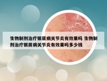 生物制剂治疗银屑病关节炎有效果吗 生物制剂治疗银屑病关节炎有效果吗多少钱