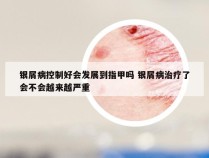 银屑病控制好会发展到指甲吗 银屑病治疗了会不会越来越严重