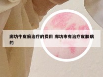廊坊牛皮癣治疗的费用 廊坊市有治疗皮肤病的