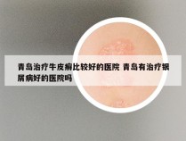 青岛治疗牛皮癣比较好的医院 青岛有治疗银屑病好的医院吗