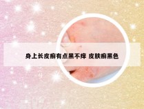 身上长皮癣有点黑不痒 皮肤癣黑色