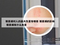银屑病对人的最大伤害有哪些 银屑病的影响 银屑病有什么危害