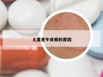 儿童患牛皮癣的原因
