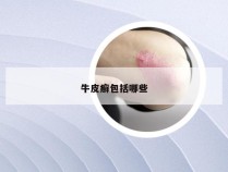 牛皮癣包括哪些