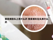银屑病张头上用什么药 银屑病长在头用什么药