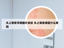 头上银屑早期图片症状 头上银屑病是什么原因