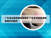 广东省治银屑病哪里最好 广东省治银屑病哪里最好的医院